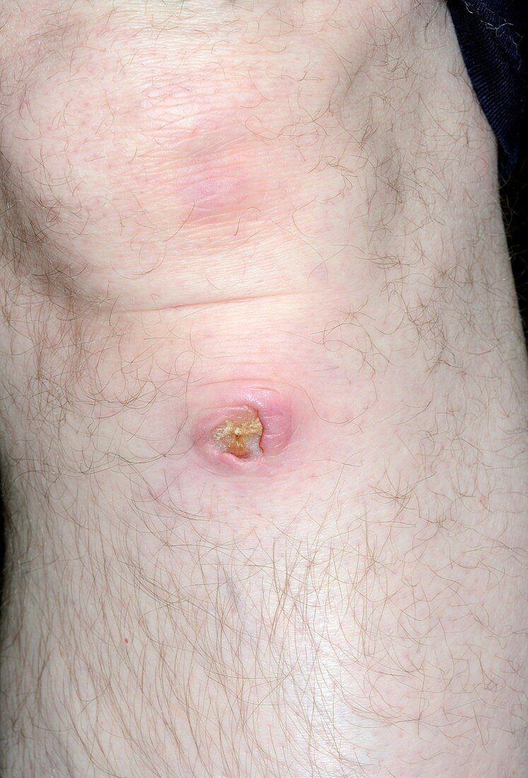 Ulcer below the knee