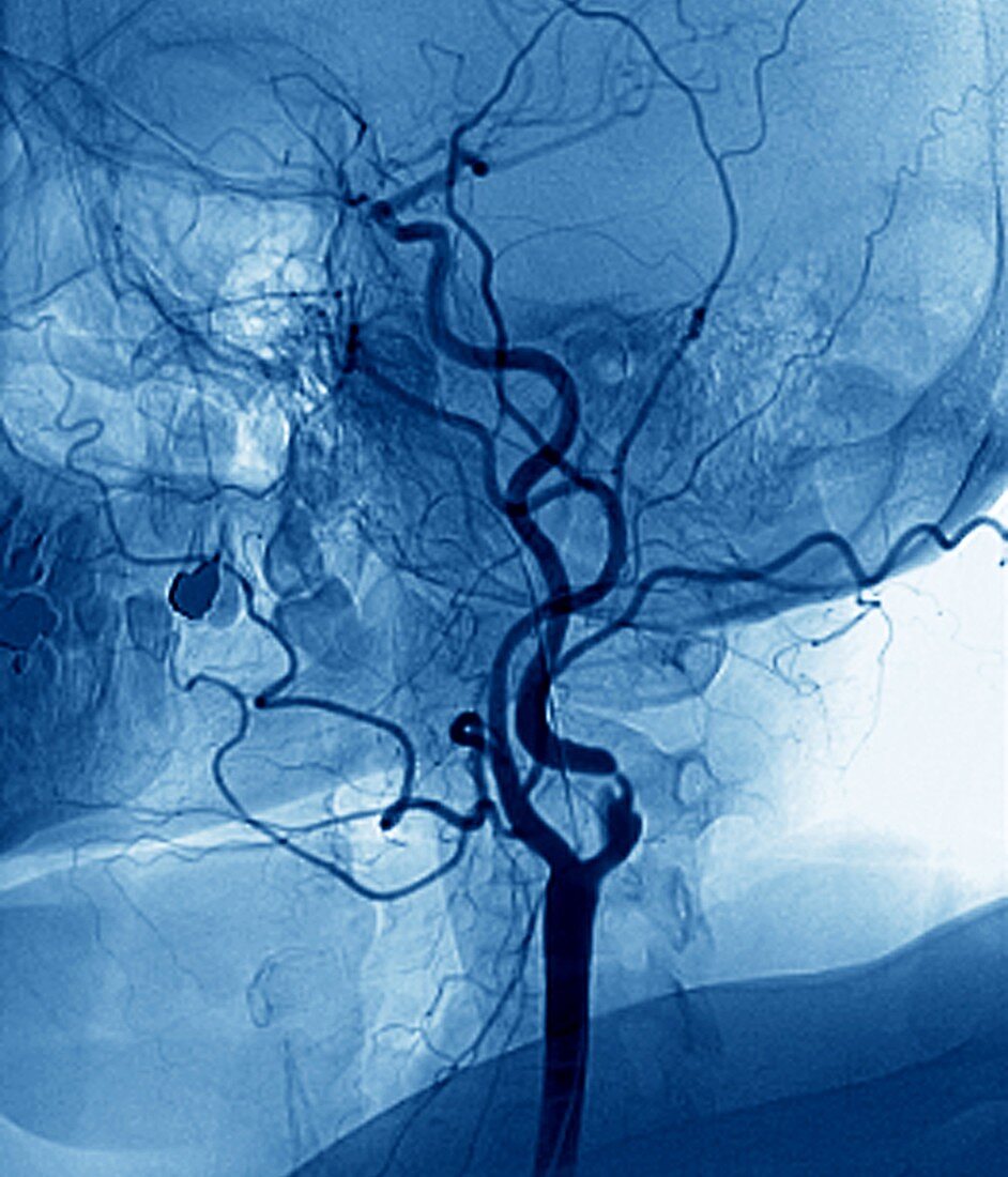 Narrowed neck artery,angiogram