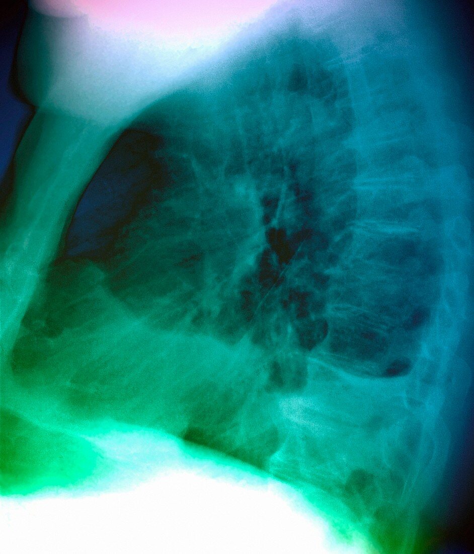 Pleural effusion,X-ray