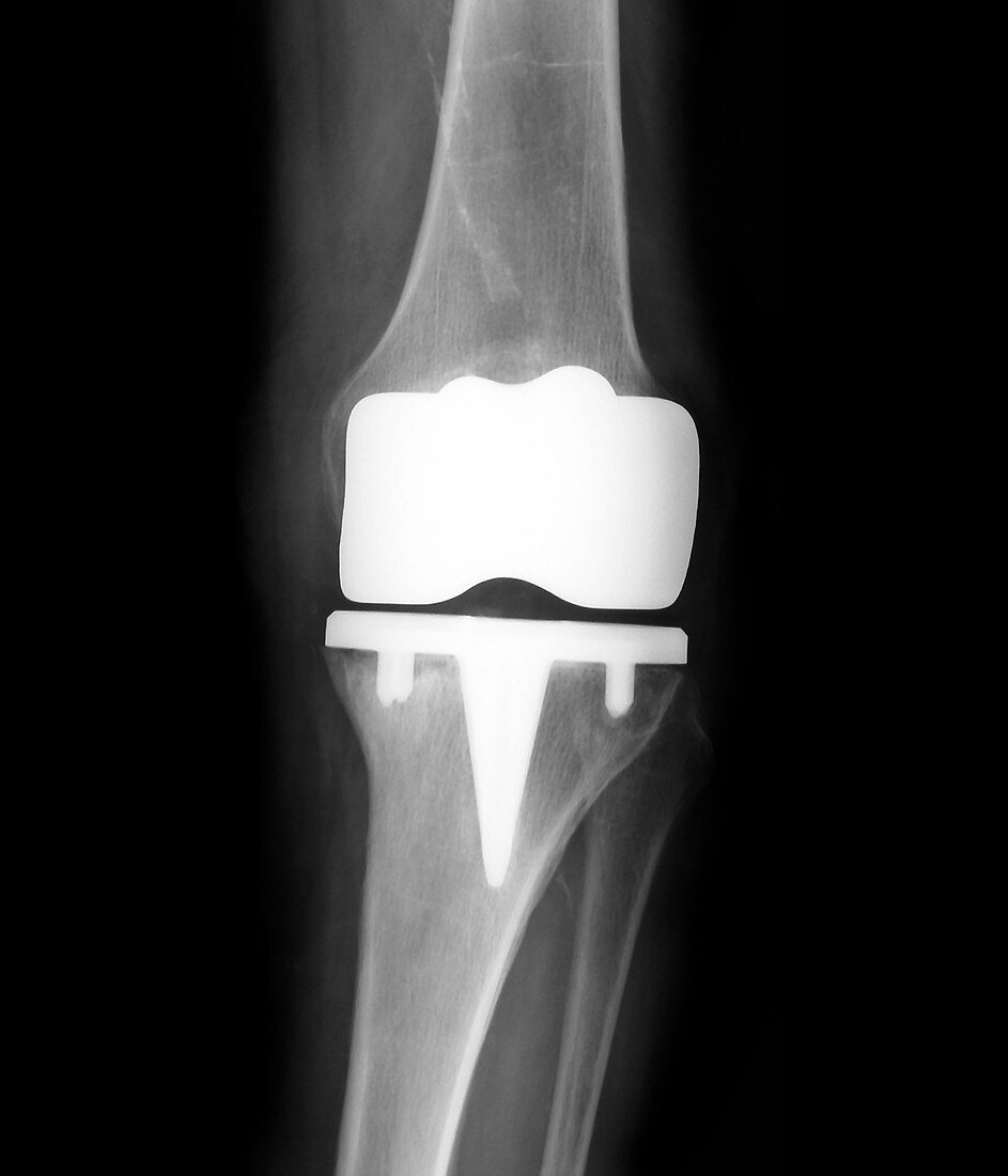 Prosthetic knee joint,X-ray