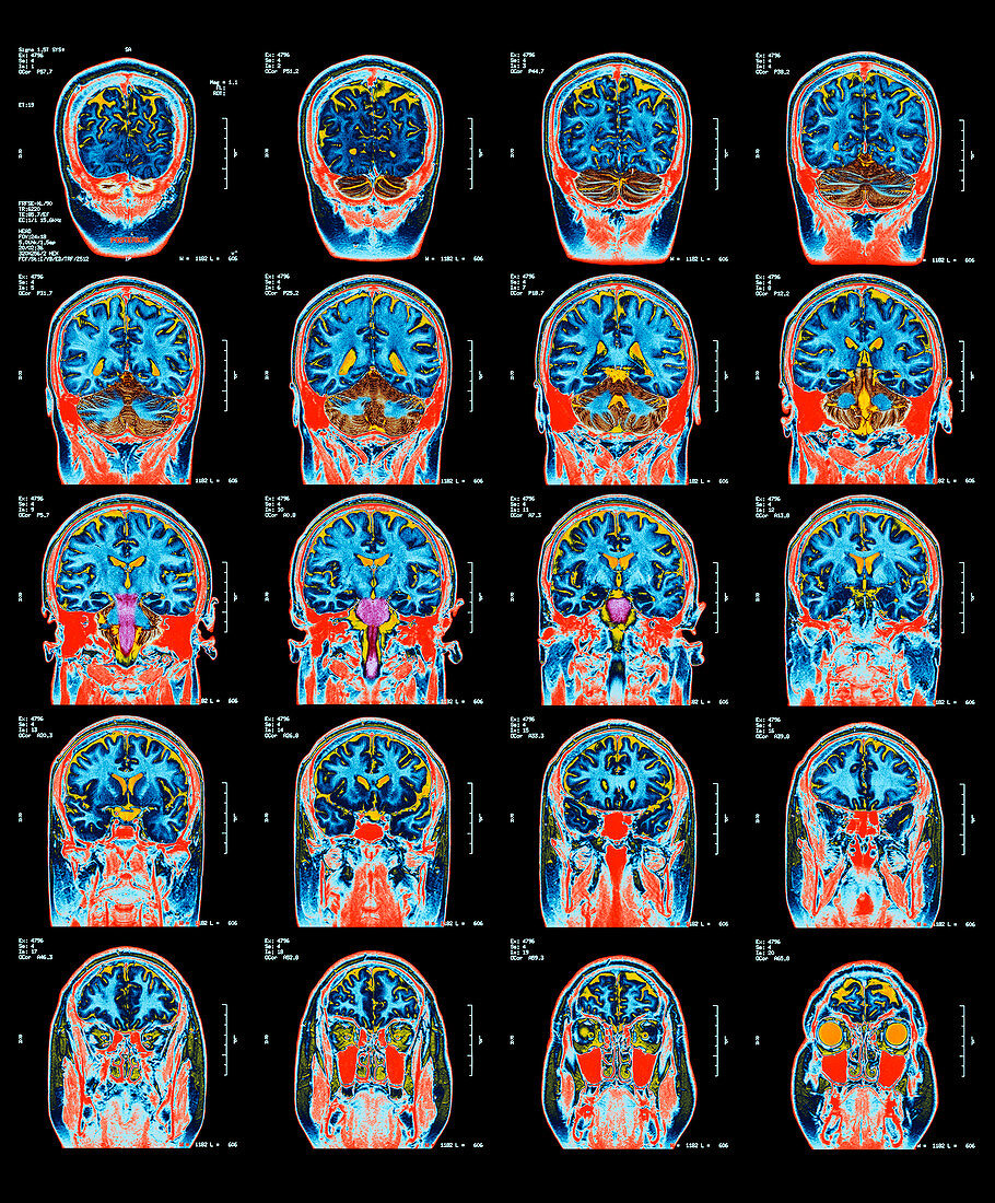 Healthy brain,MRI scans