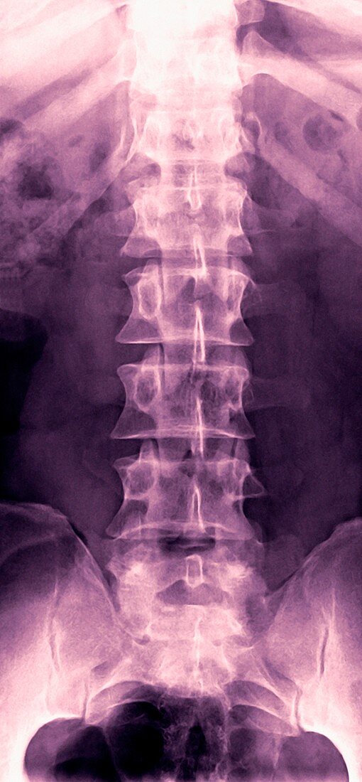 Normal lumbar spine,X-ray
