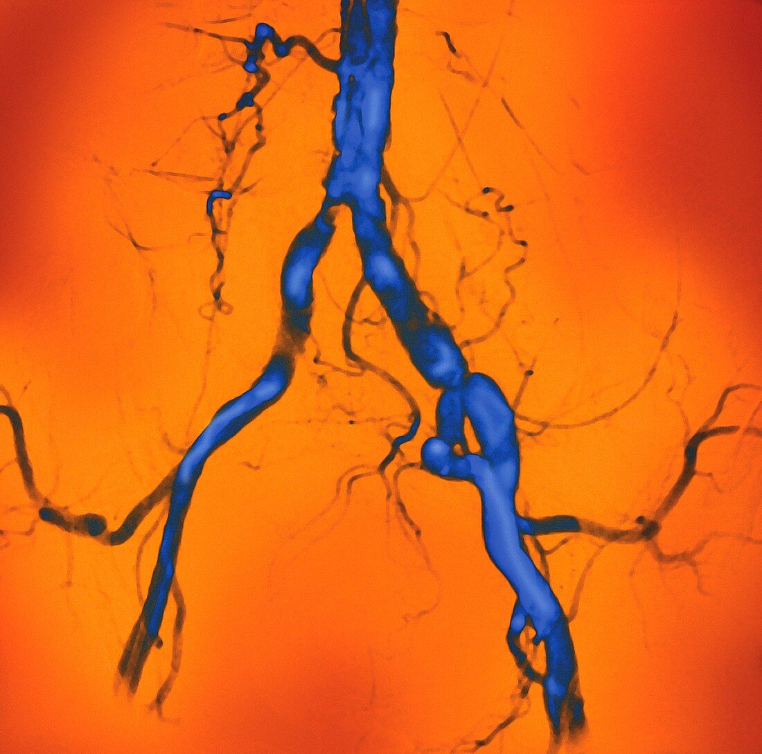 Narrowed abdominal arteries,angiogram
