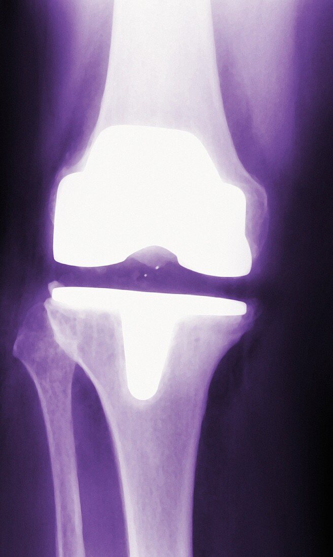 Prosthetic knee,X-ray