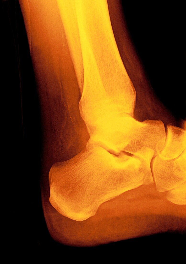 Normal ankle joint,X-ray