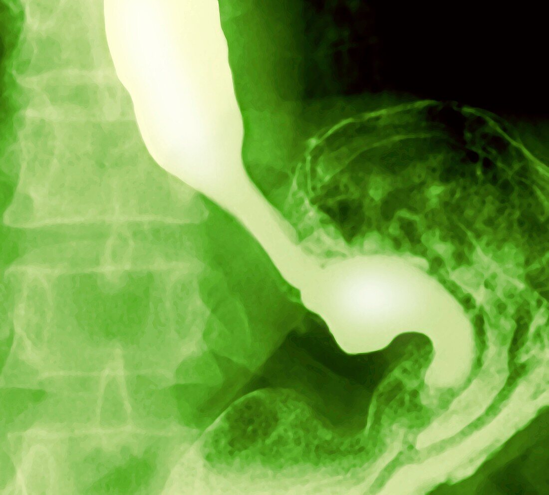 Normal oesophagus and stomach,X-ray