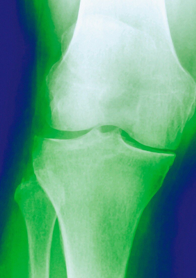 Arthrosis of the knee,X-ray
