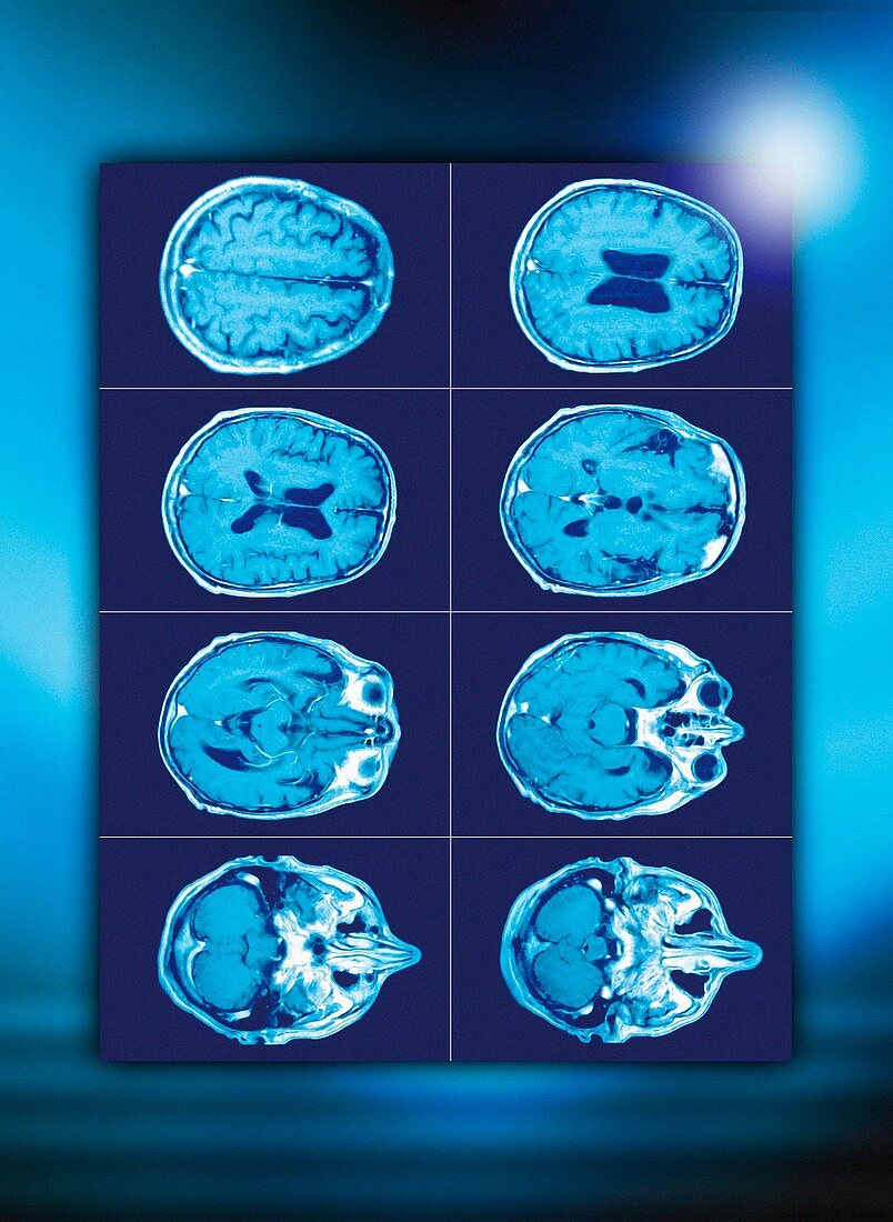 Normal brain,CT scans