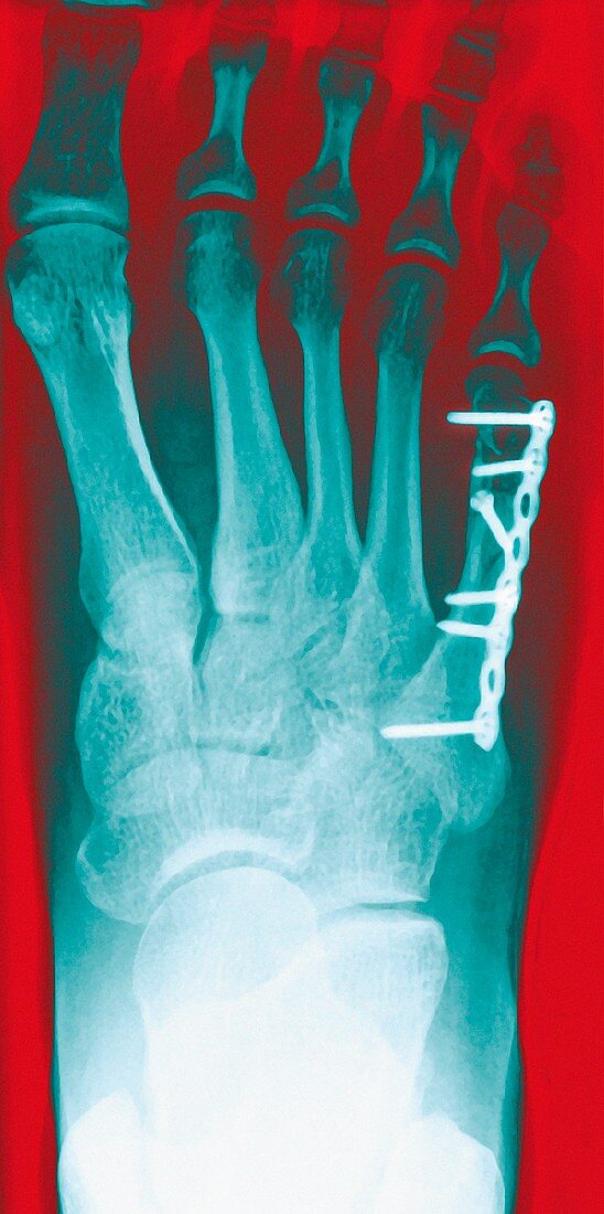 Pinned foot bone fracture,X-ray