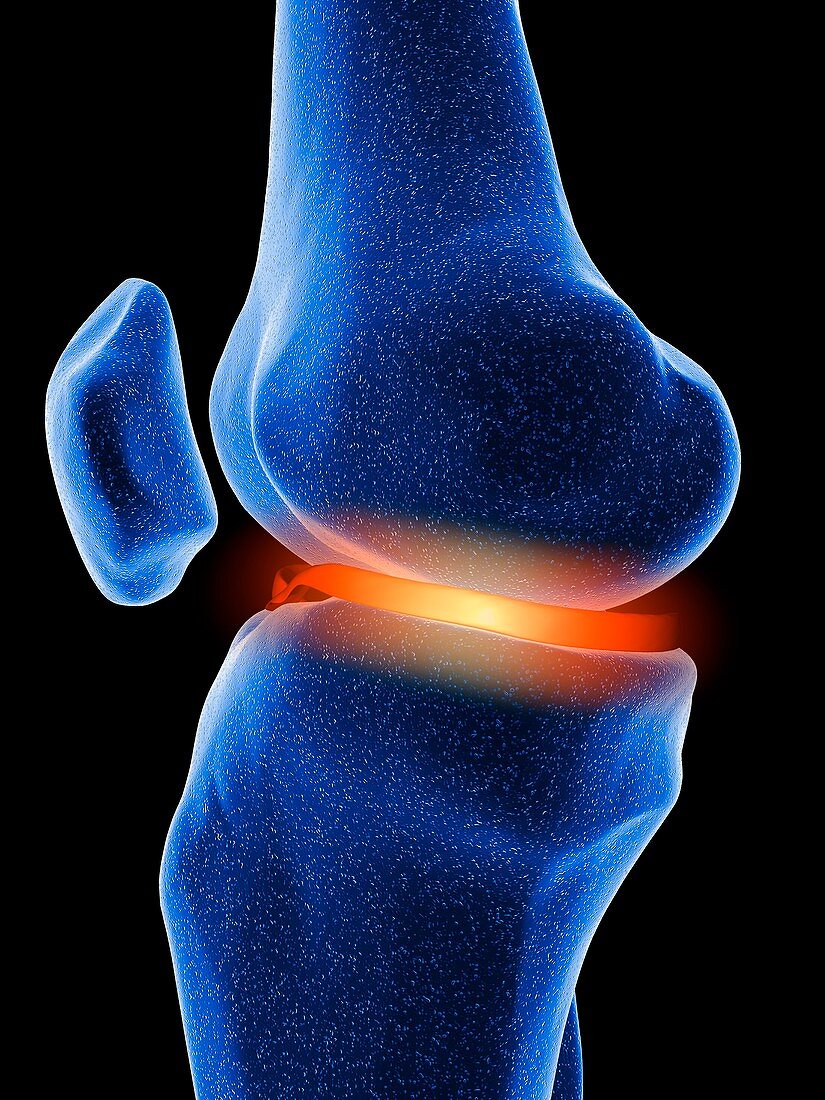 Inflamed knee cartilage,computer artwork