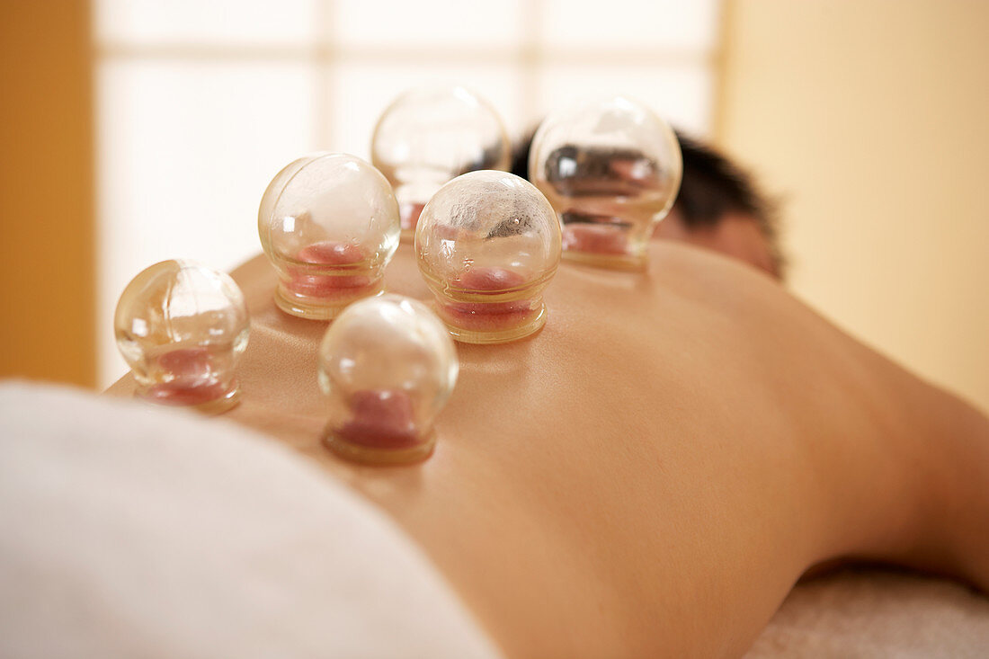 Cupping