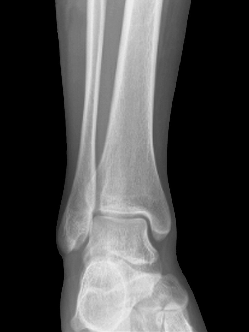 Normal ankle joint,X-ray