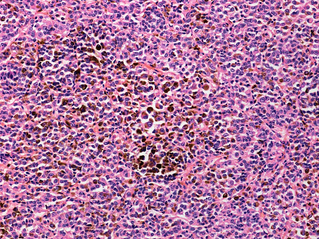 Secondary liver cancer,light micrograph