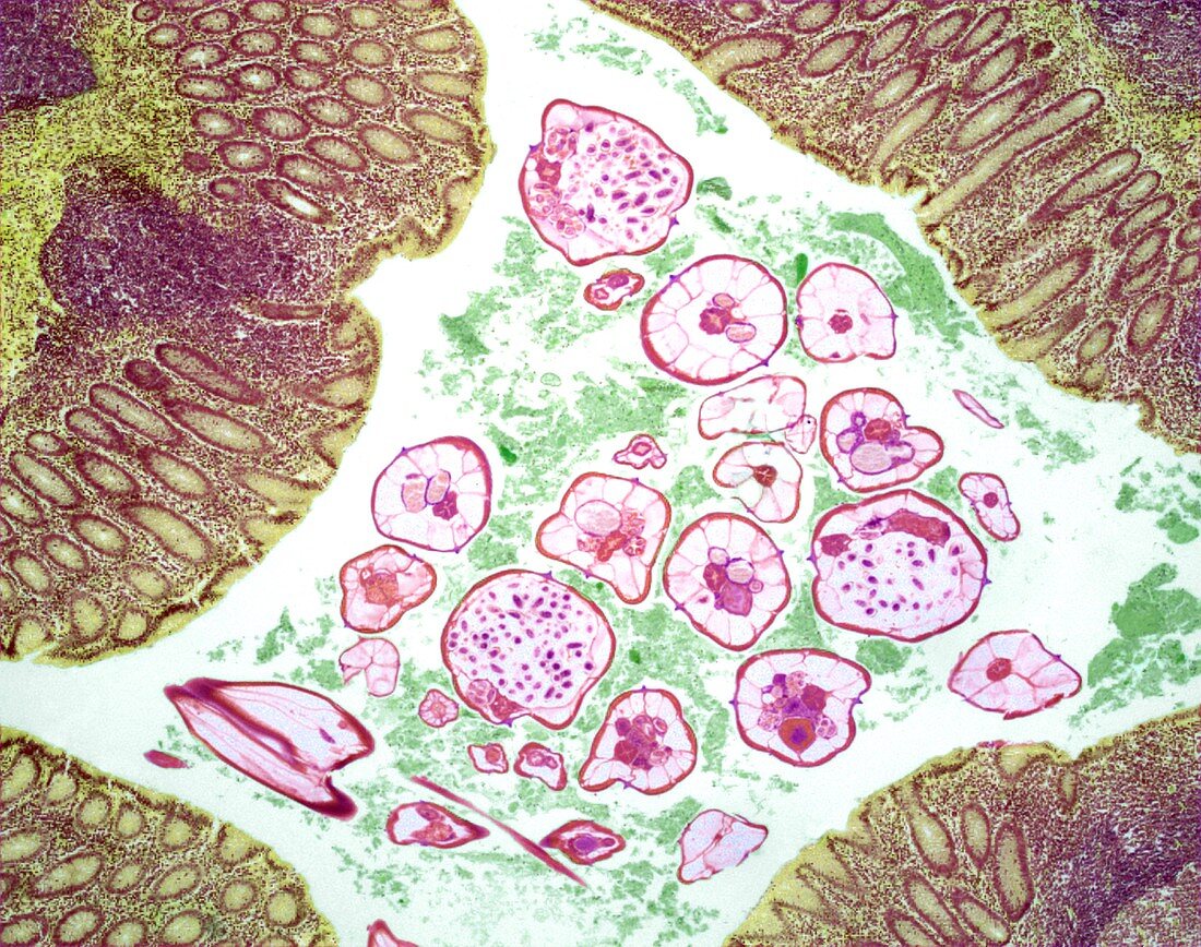 Nematode infection,light micrograph