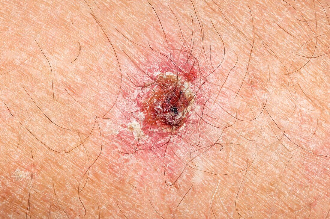 Skin cancer