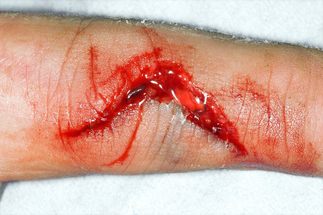 Lacerated finger