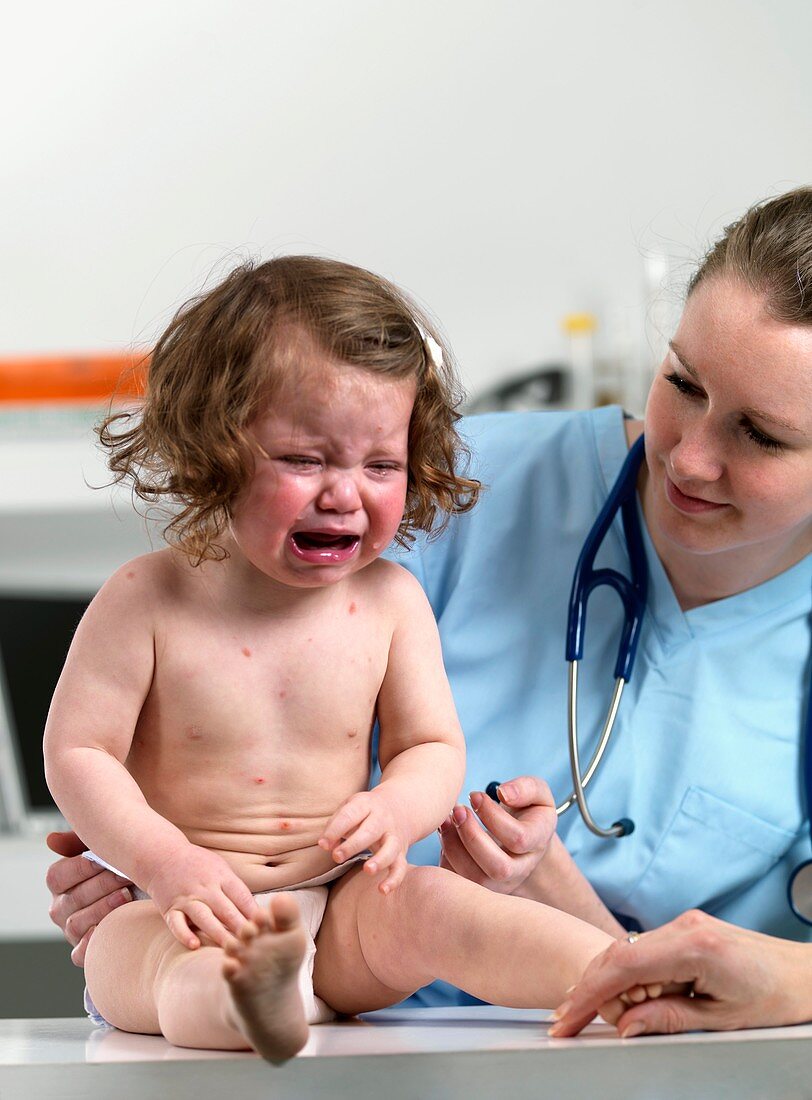 Baby with chickenpox