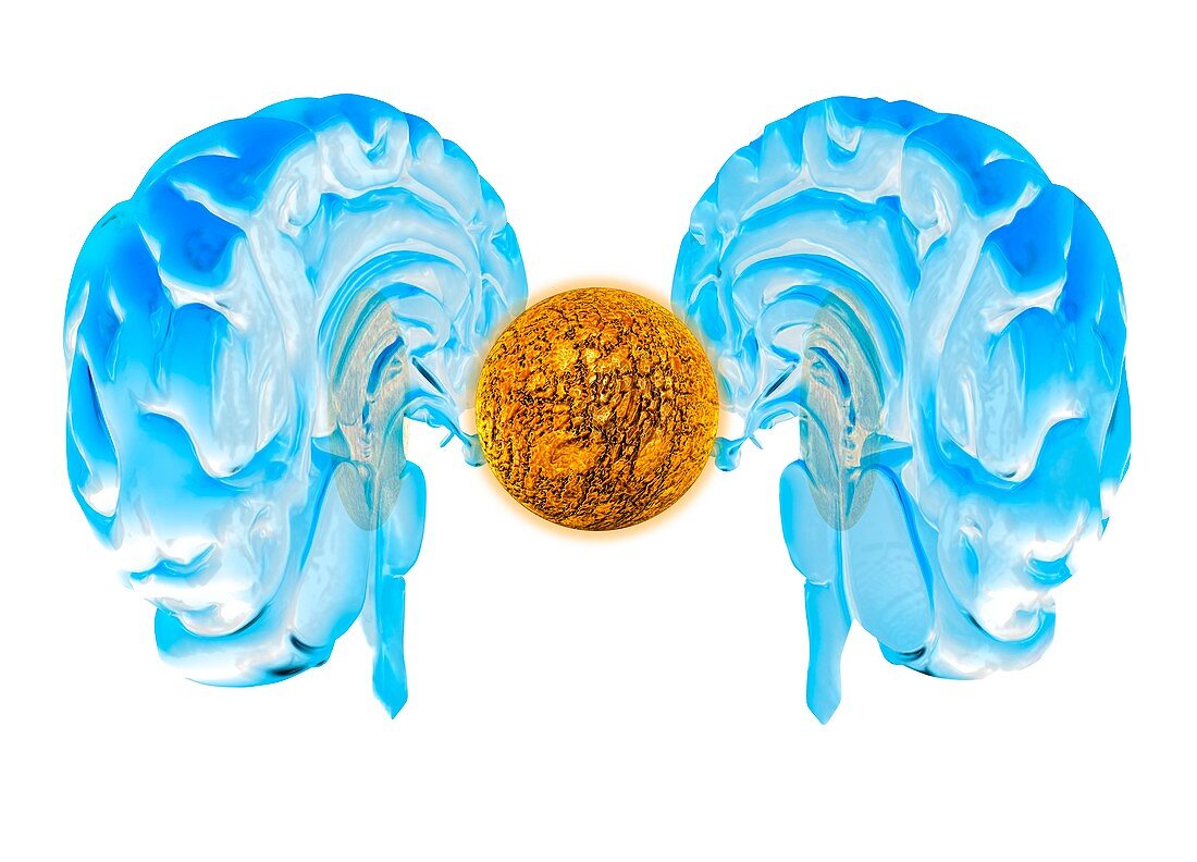 Brain cancer,conceptual artwork