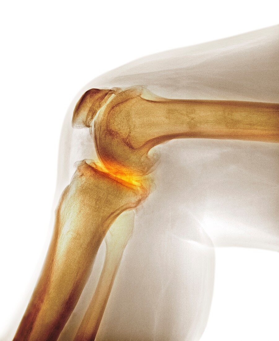 Arthritis of the knee,X-ray