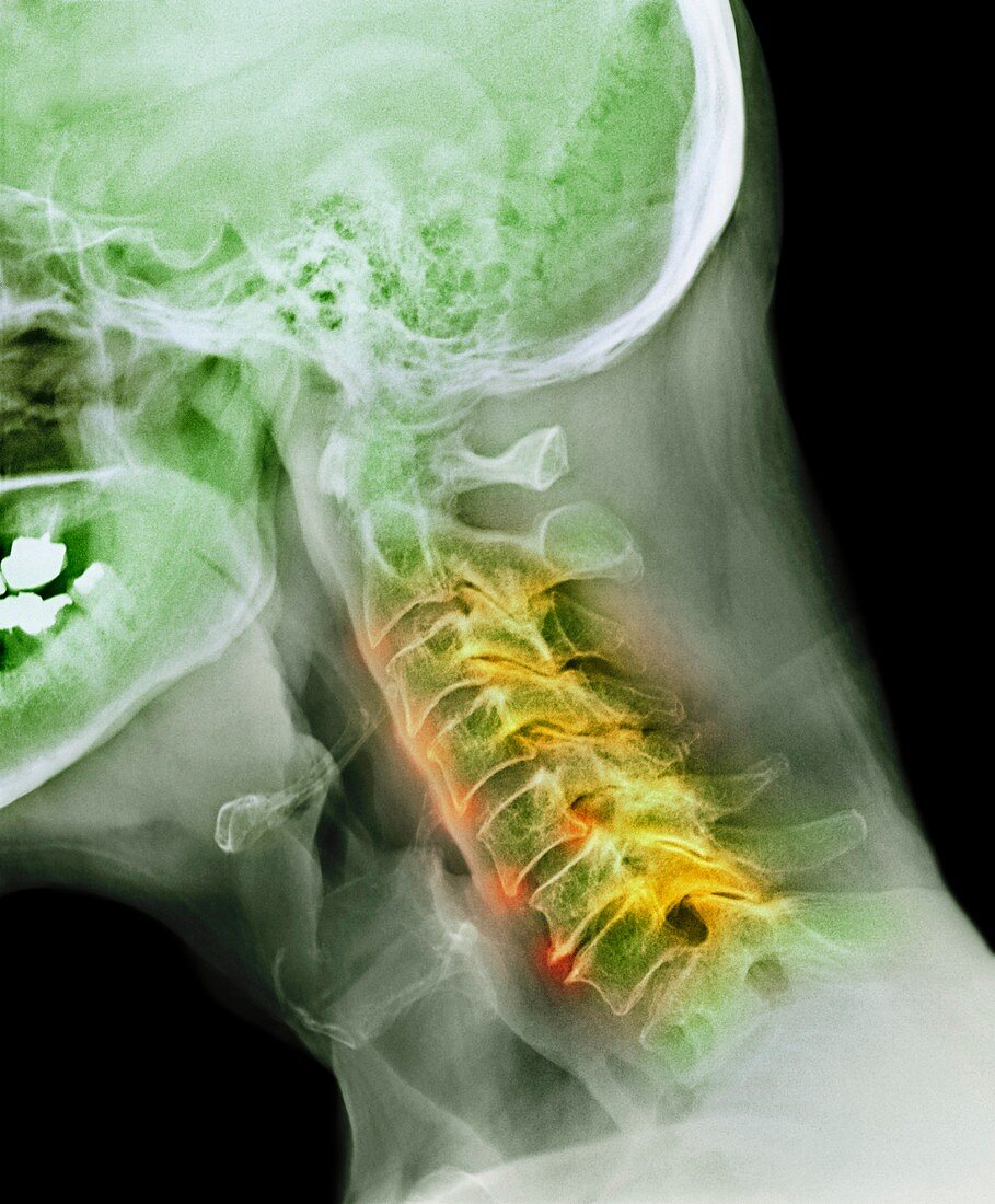 Arthritis of the neck,X-ray