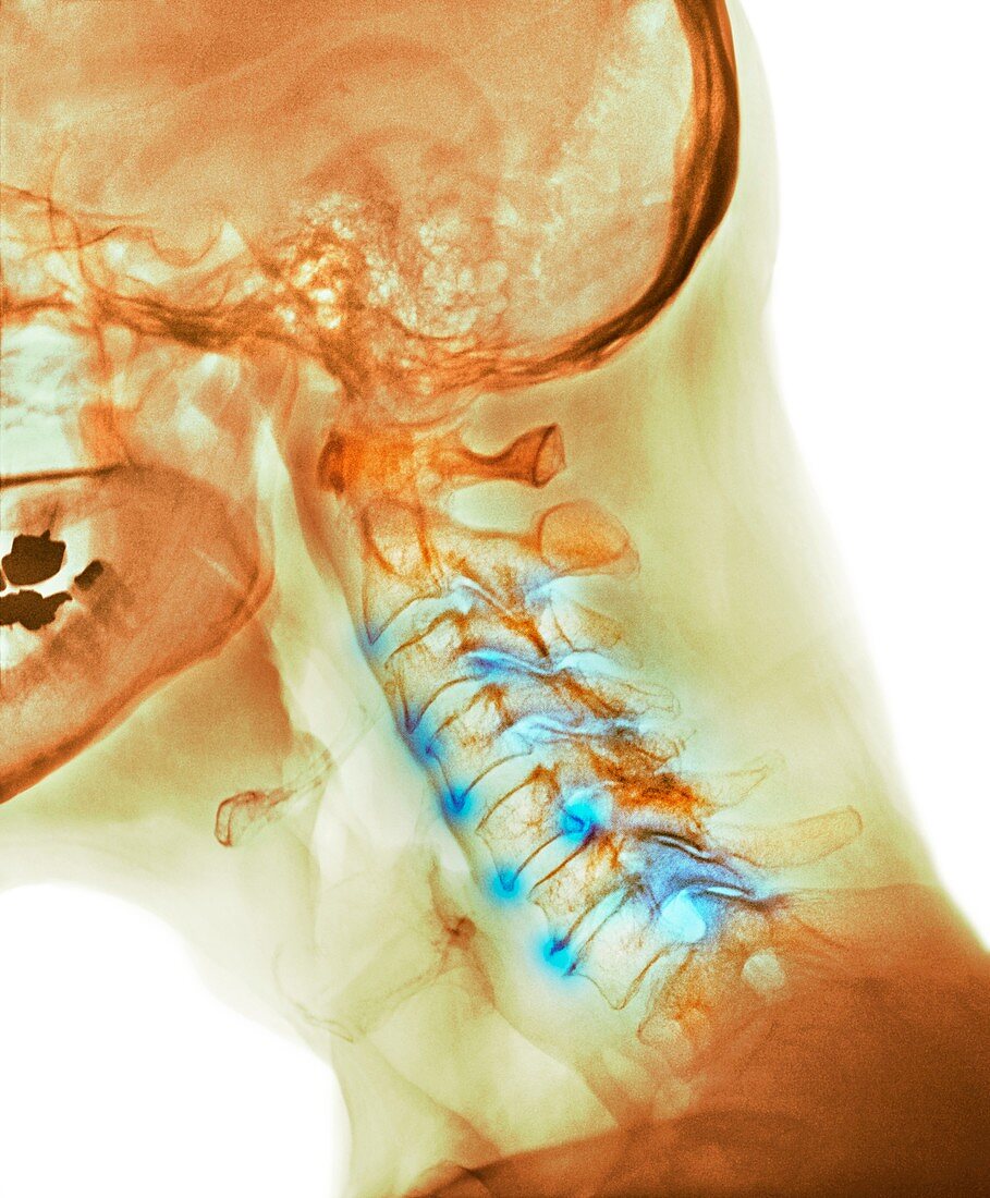 Arthritis of the neck,X-ray