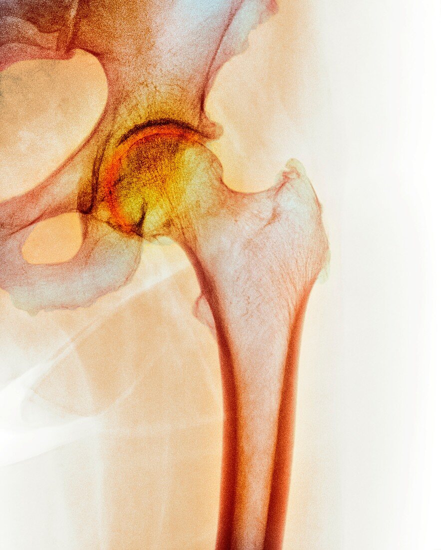 Arthritis of the hip,X-ray