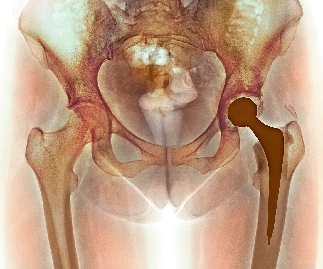 Loosened hip replacement,X-ray