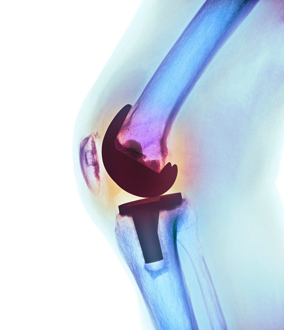 Knee replacement,X-ray