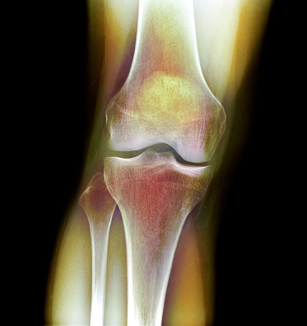 Normal knee,X-ray