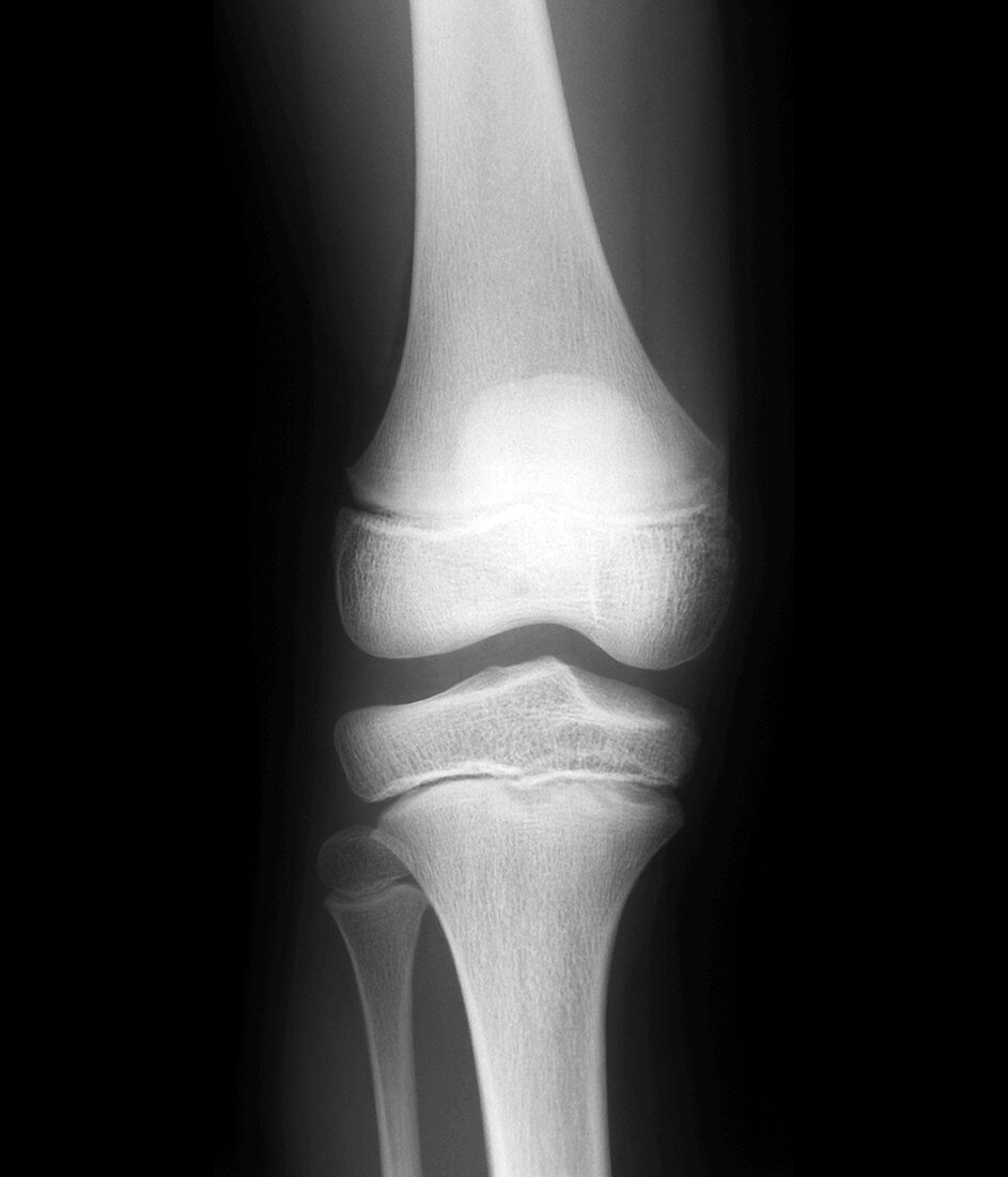 Normal child's knee,X-ray