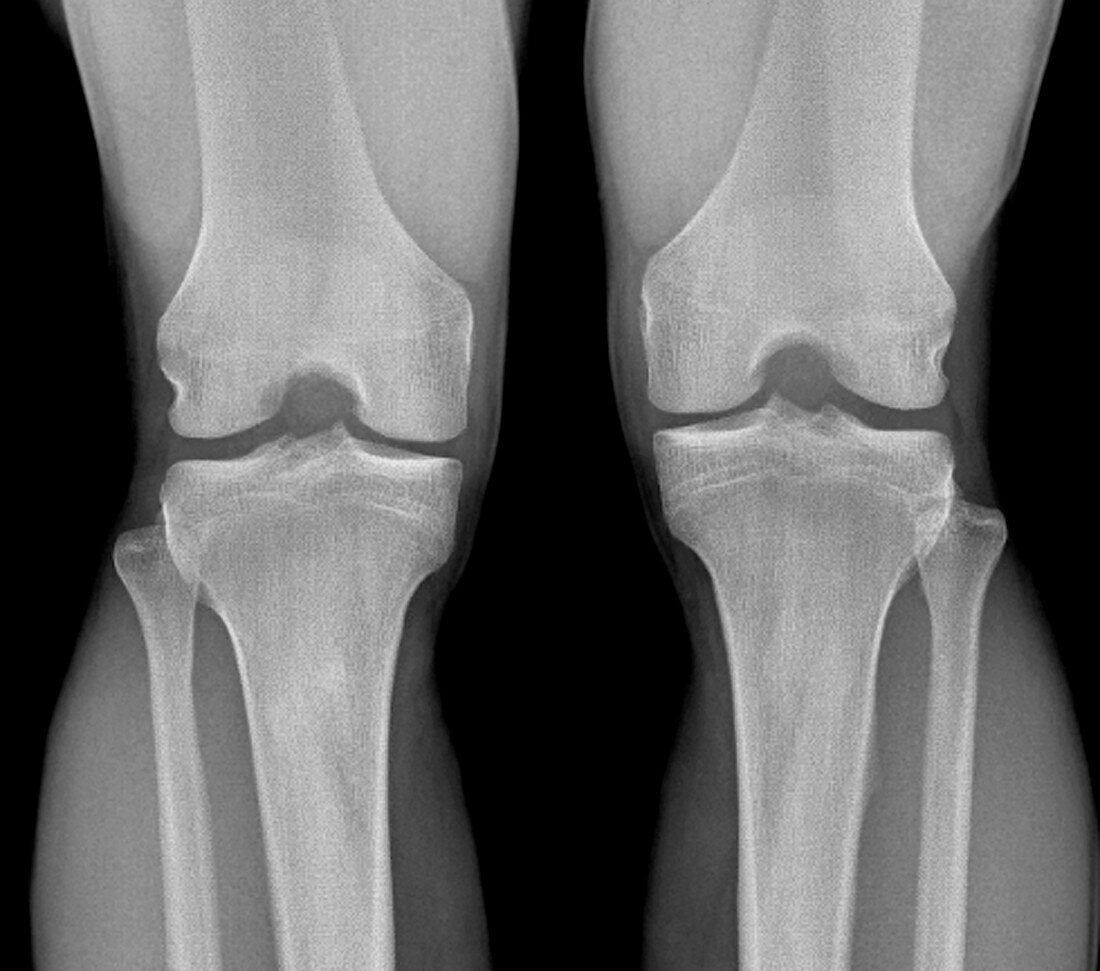Normal knees,X-ray