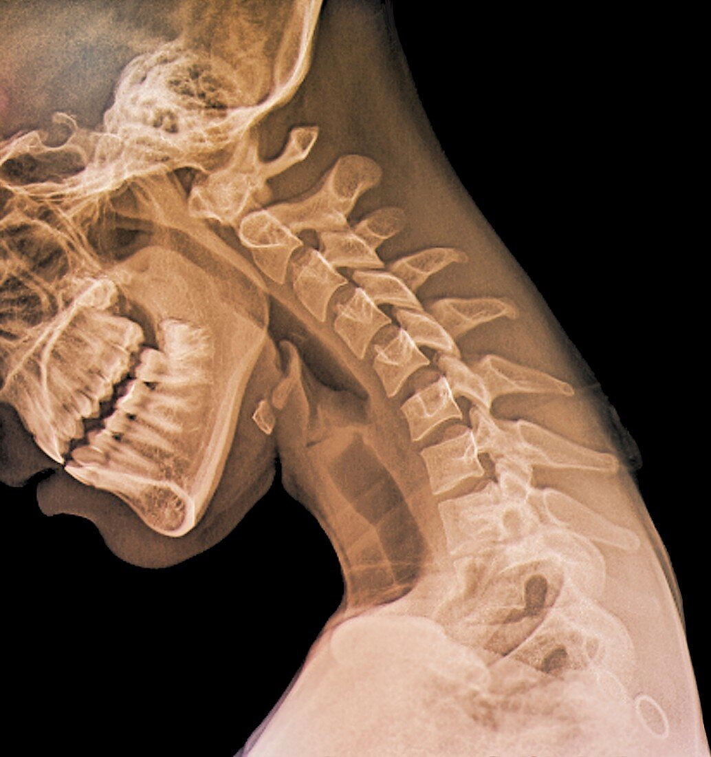 Normal flexed neck,X-ray