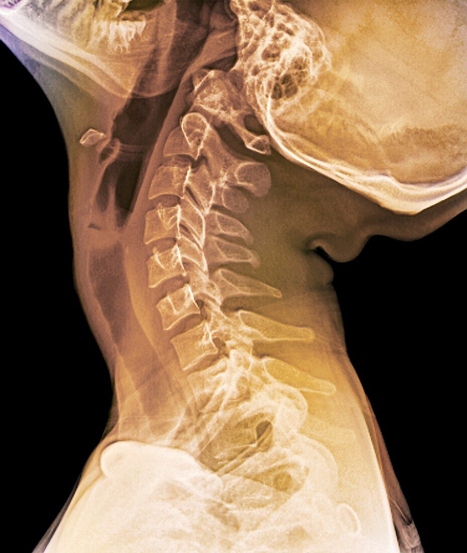 Normal extended neck,X-ray