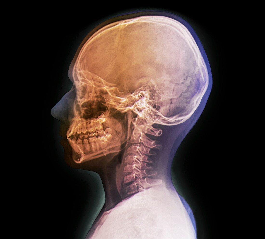 Normal child's head,X-ray