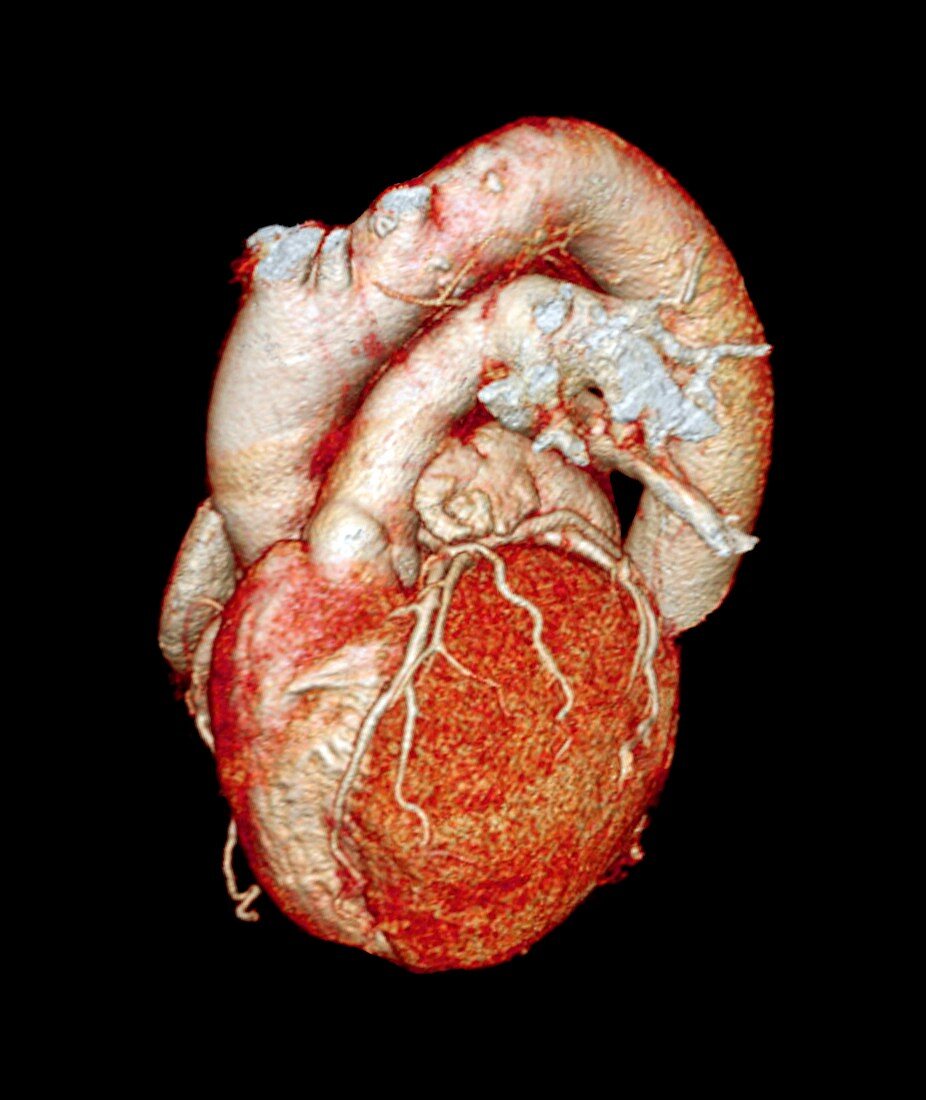 Normal heart,3D CT scan