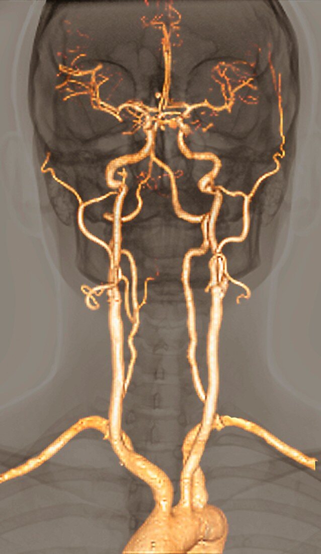 Normal arteries,3D CT scan