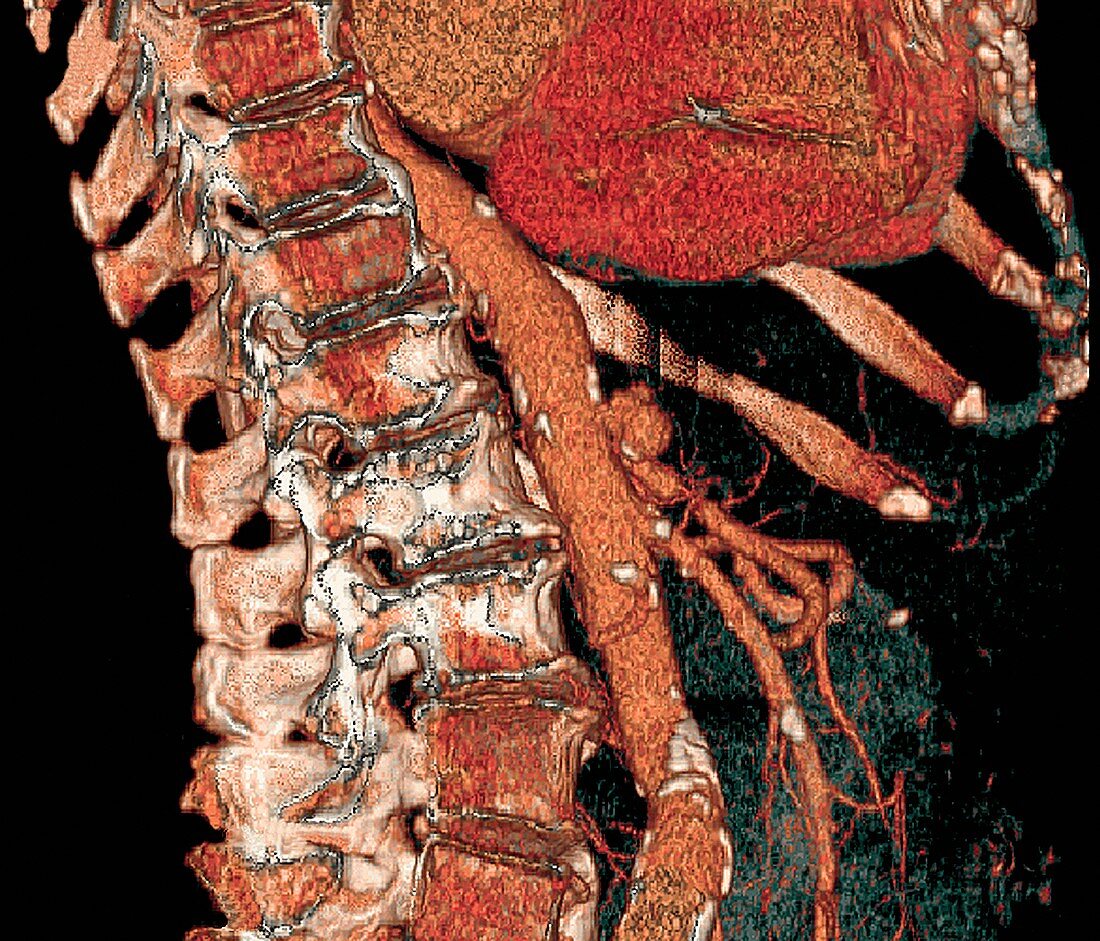 Abdominal aorta and spine,3D CT scan