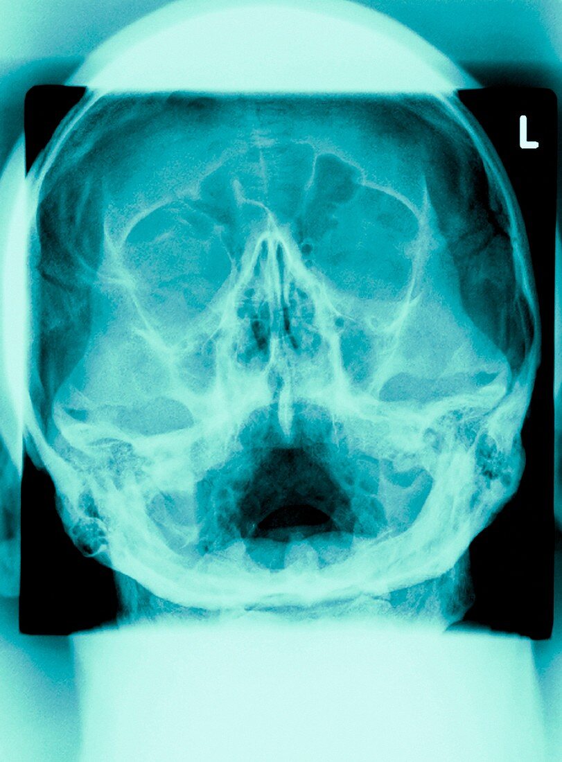 Healthy skull,X-ray