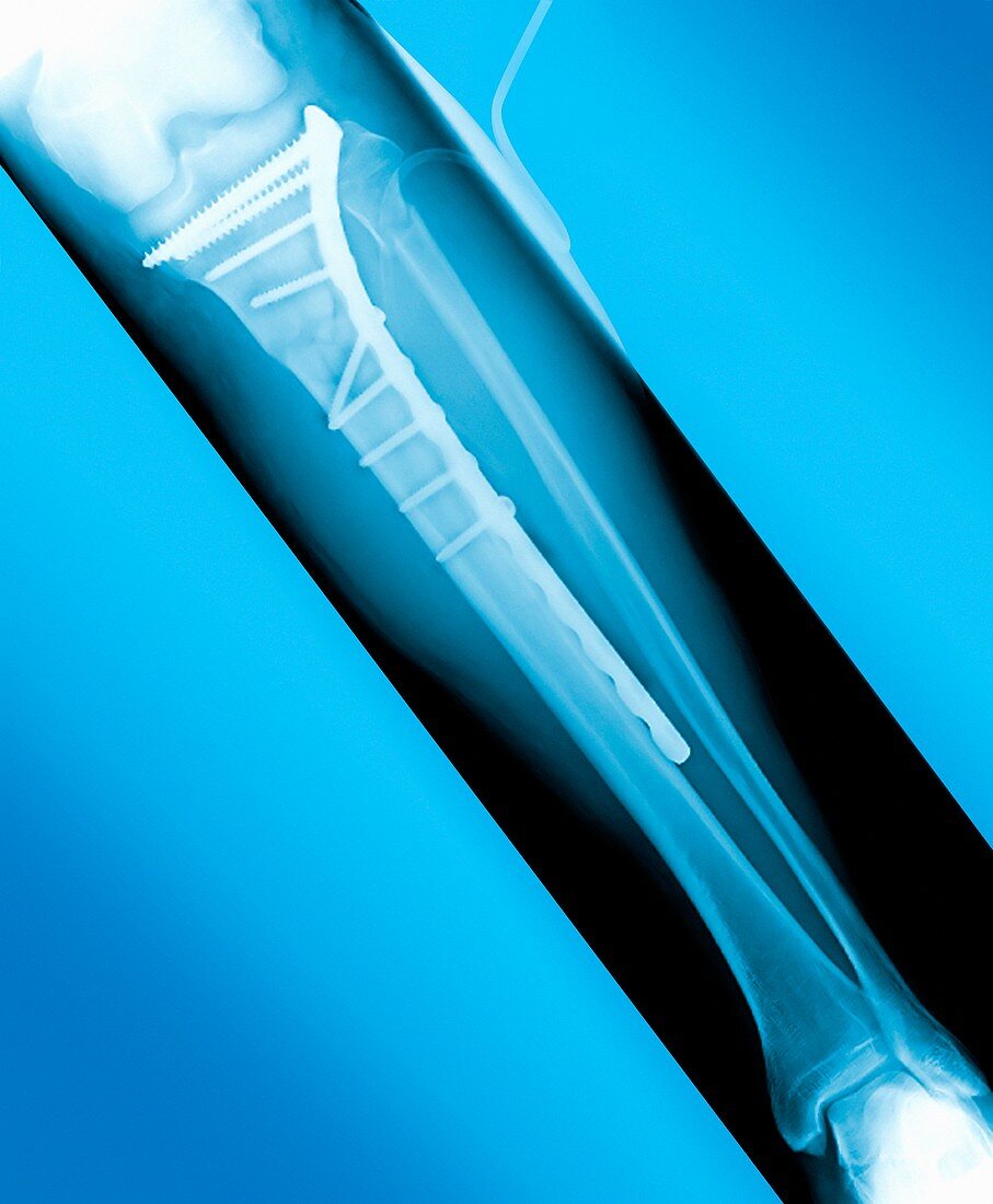 Pinned broken leg,X-ray