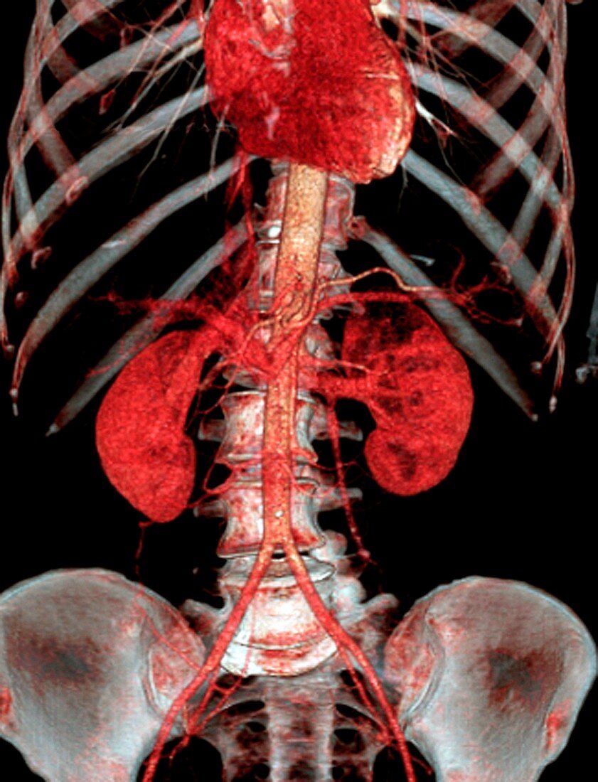 Normal abdomen,3D CT scan