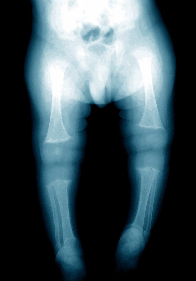 Rickets,X-ray