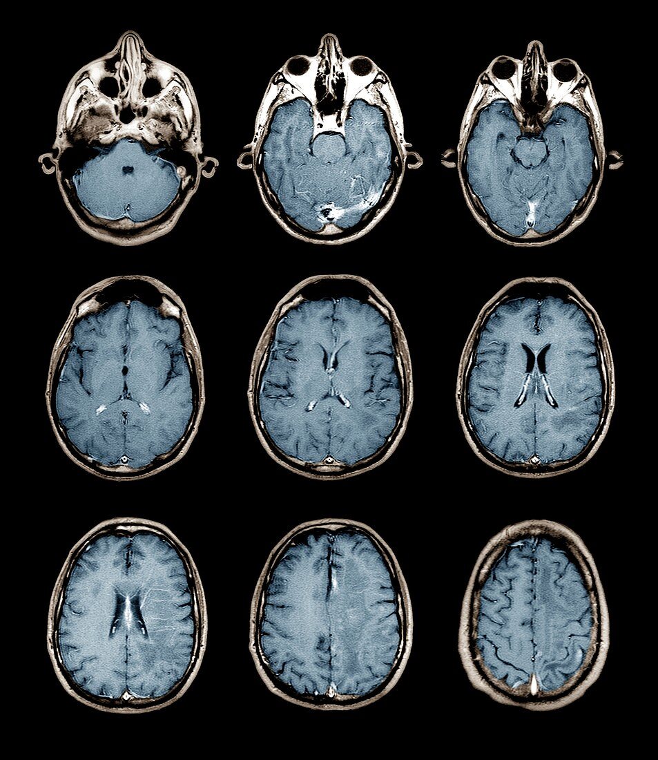 Normal brain,MRI scans
