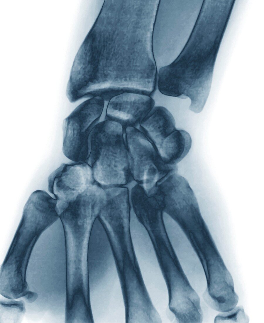 Normal wrist,X-ray