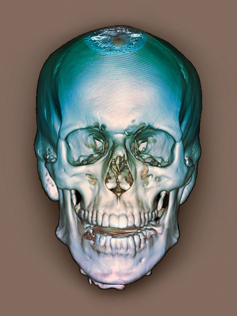 Normal skull,3D CT scan