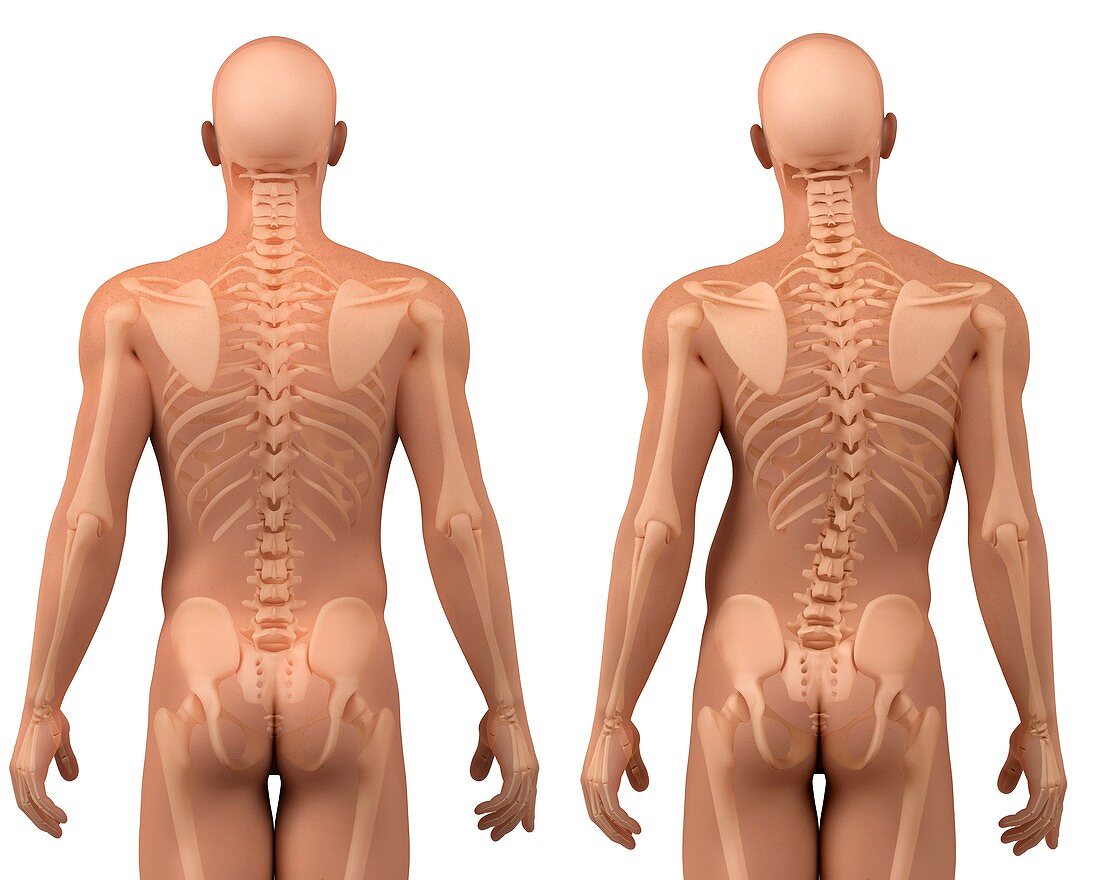 Scoliosis of the spine,artwork
