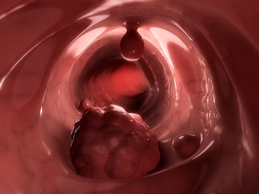 Colon cancer,artwork