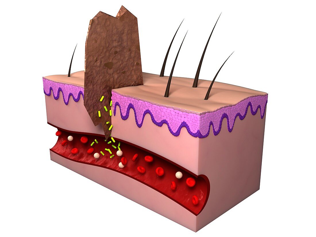 Wound infection,artwork