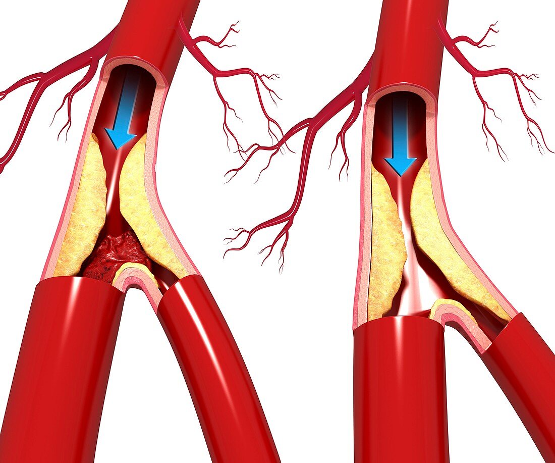 Atherosclerosis,artwork