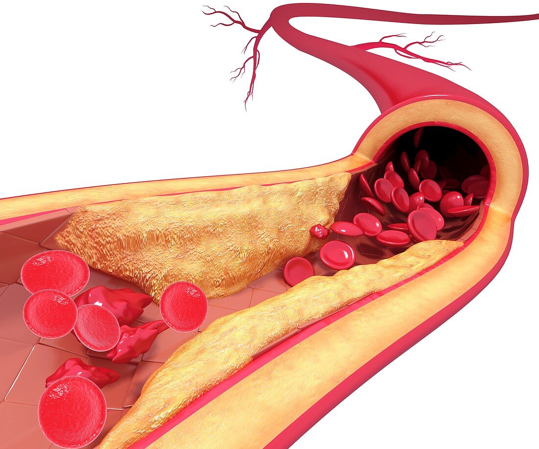 Atherosclerosis,artwork