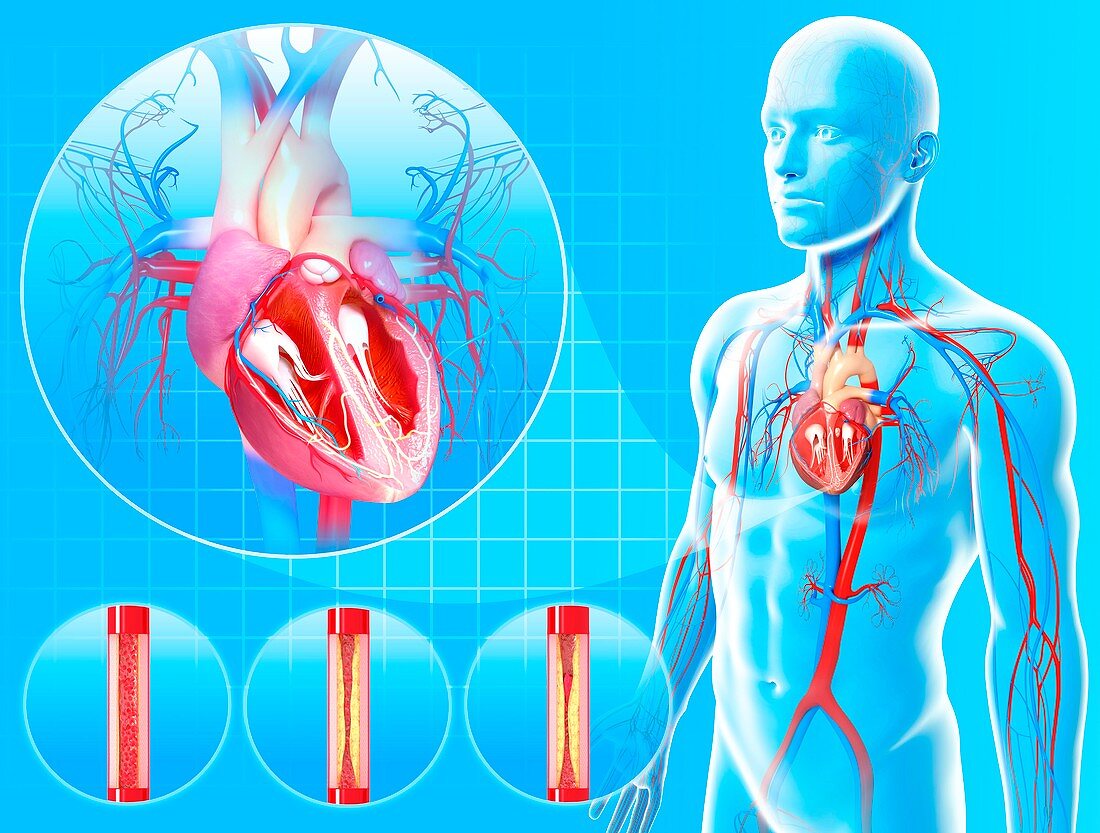 Atherosclerosis,artwork